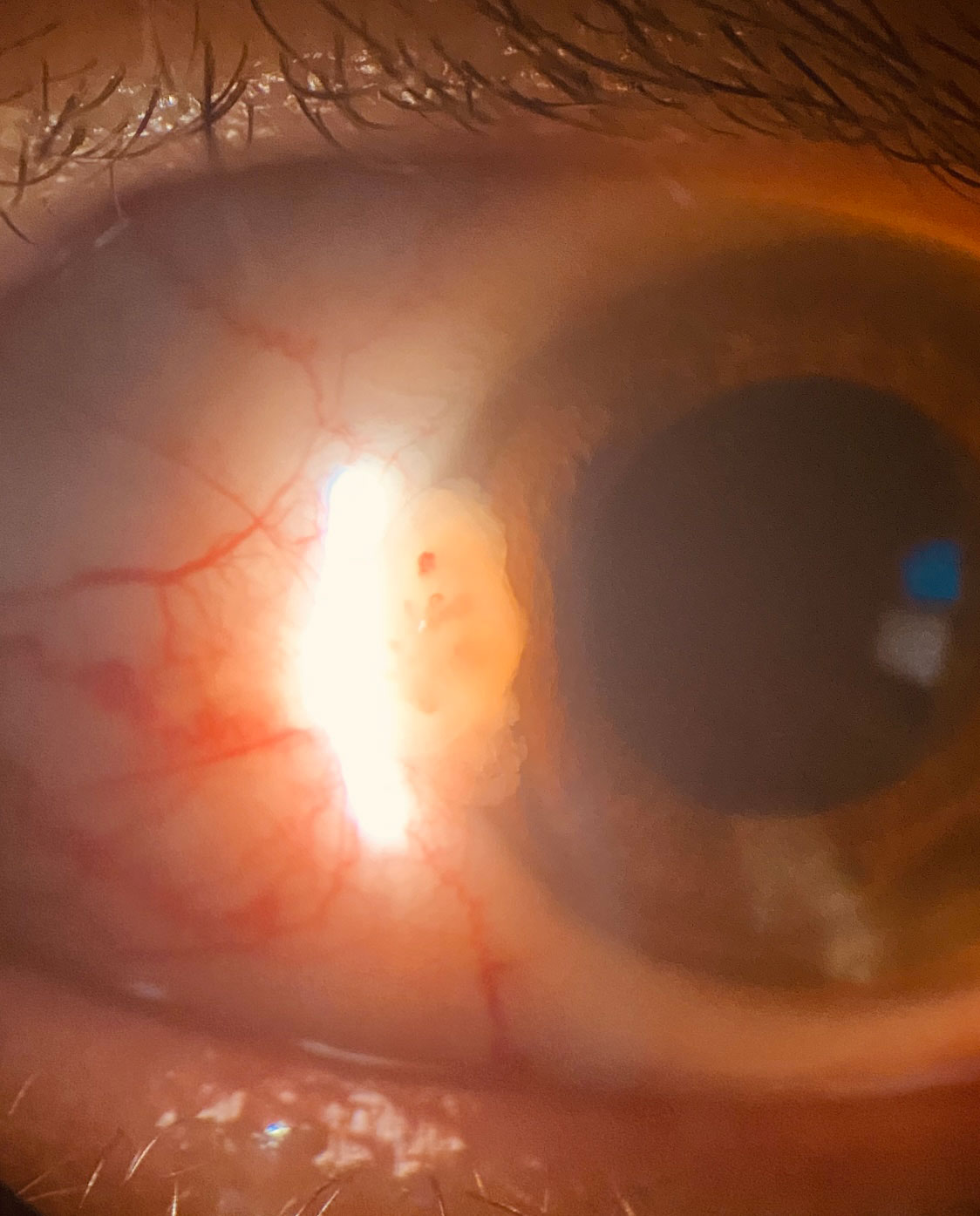  Pterygium Surgery